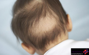 ریزش مو در نوزادان