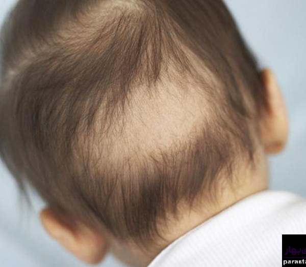 ریزش مو در نوزادان